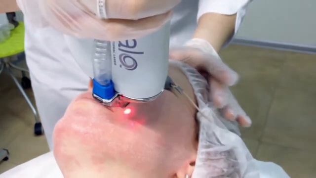 Лазерное омоложение кожи Halo в Набережных Челнах смотреть онлайн