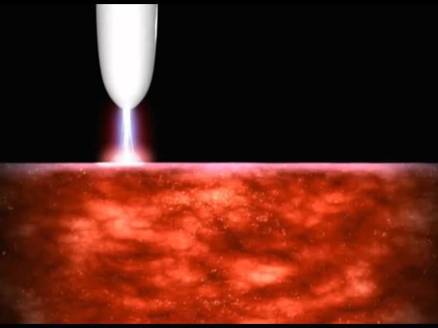 Принцип метода аргоноплазменной коагуляции смотреть онлайн