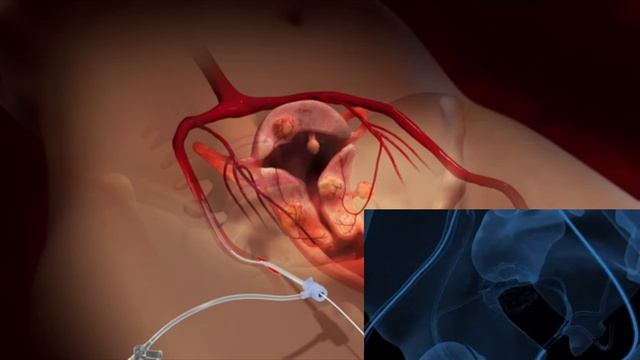 Эмболизация маточных артерий является оптимальным решением в лечении миомы смотреть онлайн