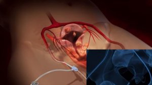 Эмболизация маточных артерий является оптимальным решением в лечении миомы