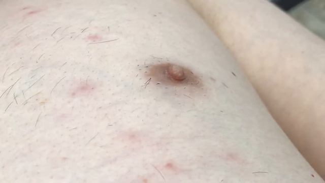 Как проучить мужа) или лазерная эпиляция мужской груди смотреть онлайн