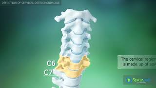 Шейный остеохондроз