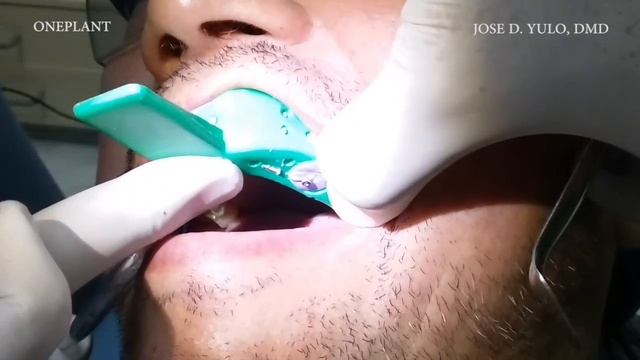 AFTER IMPLANT PLACEMENT by DR. JOSE D. YULO смотреть онлайн