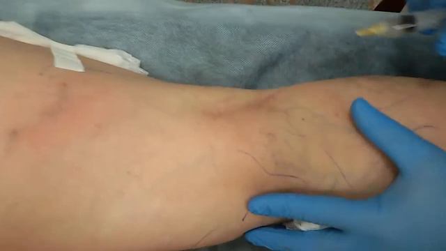Склеротерапия в клинике современной флебологии. Уфа. смотреть онлайн