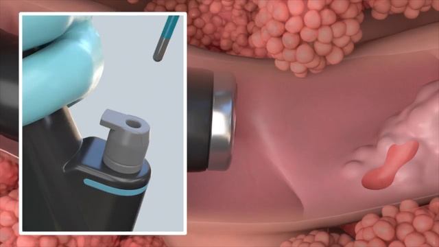CHEST Foundation - Learn About Lung Biopsies смотреть онлайн