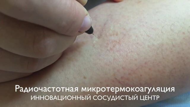Радиочастотная микротермокоагуляция капилляров смотреть онлайн