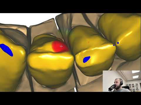 Exocad 3.1 rijeka modelling dental cad exocad video exocad Video Tutorial Моделирование в exocad 2