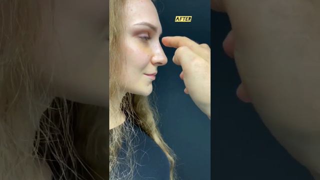 Ринопластика: до и через 8 дней смотреть онлайн