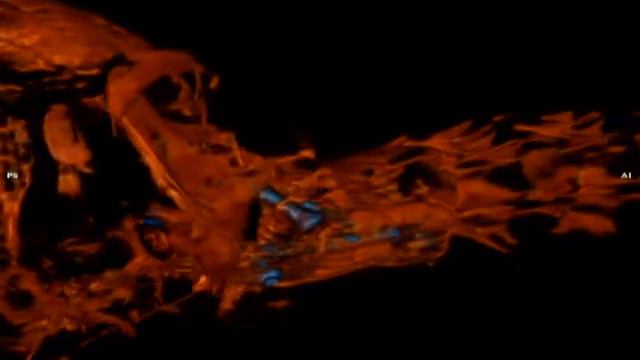 Вентральная стабилизация атланто-аксиальной нестабильности смотреть онлайн