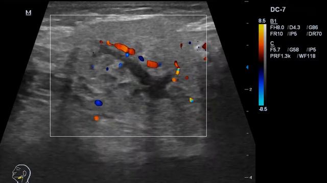 Калькулезный сиалоаденит смотреть онлайн