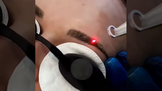 Удаление татуажа бровей