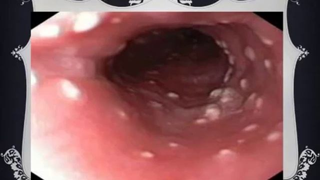 Грибковая инфекция кандида альбиканс. смотреть онлайн