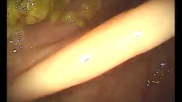 удаление полипа в сигмовидной кишке. Гастроцентр АС Медикэл смотреть онлайн