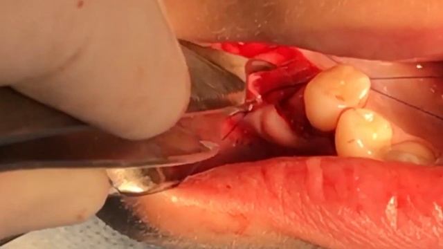 Dental Implant Procedure (after bone graft) part 2 / Дентальная Имплантация (после костного блока) смотреть онлайн