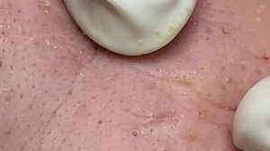 Acne treatment for Spa Linh Mun 2023 #003