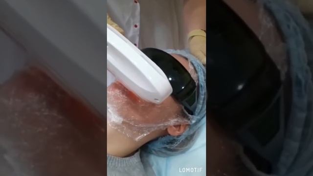 Лазерная эпиляция лица смотреть онлайн