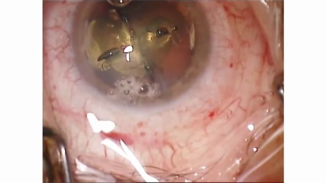Dr. O. Kermani - Operation Grauer Star – So funktioniert das mit dem Femtosekundenlaser смотреть онлайн