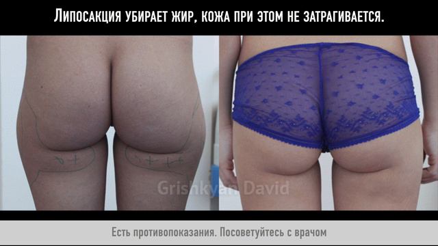 Липосакция смотреть онлайн