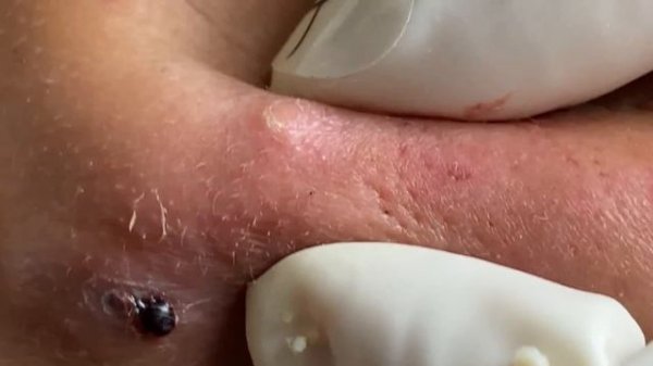 Make your Acne Treatment Huong Da Nang | 448# Hoang Part 3 | acne 2022