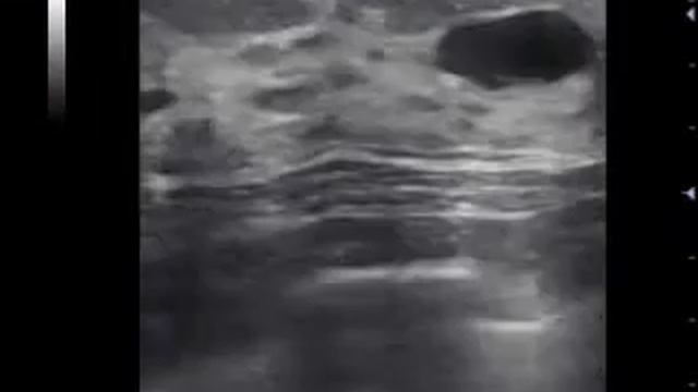УЗИ Крупная киста молочной железы смотреть онлайн