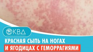?? Красная сыпь на ногах и ягодицах с геморрагиями. Клинический случай №611