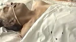 катетеризация подключичной вены по сельдингеру