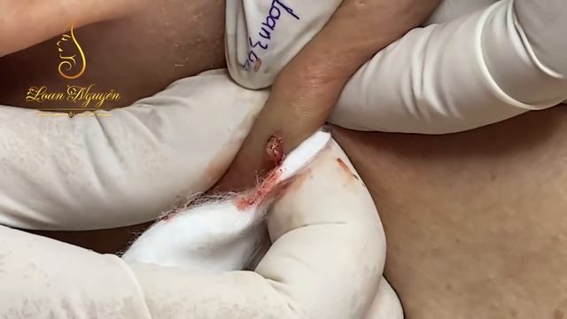Remove big CYST and SUC 20 years (344) | Loan nguyen смотреть онлайн