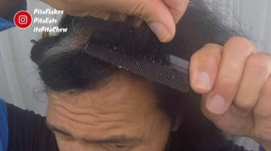 TECTONIC FLAKES MONTAGE (MAGNITUDE 1.5) | DANDRUFF ON SCALP | SEBORRHEIC DERMATITIS | PitaFlakes