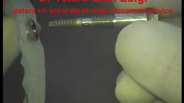 Guided Implantology NewConcepts WO2010125593 A1 case 2 смотреть онлайн