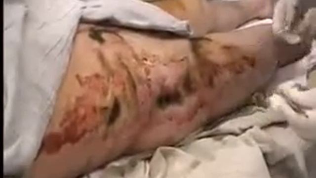 Вскрытие ожоговых пузырей смотреть онлайн