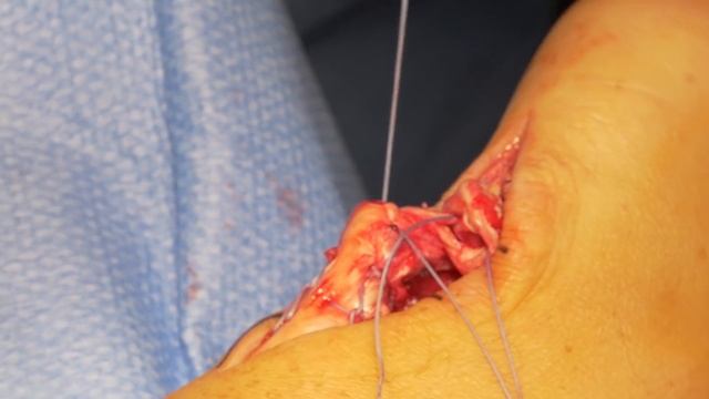 Achilles Tendon Repair With Krakow Procedure (Dr. Econopouly)