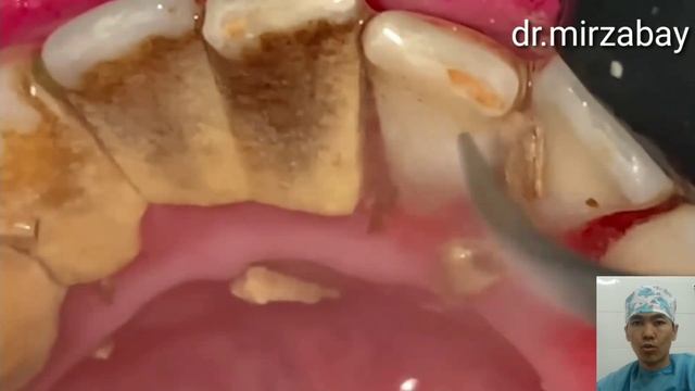 Профессиональная чистка зубов удаление зубного камня тис тастарын алу тіс тастарын тазалау | 18+ # смотреть онлайн