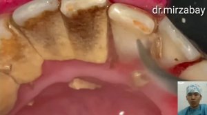 Профессиональная чистка зубов удаление зубного камня тис тастарын алу тіс тастарын тазалау | 18+ #