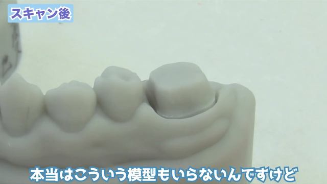虫歯全種類コンプリート💡‼️C0からC4までの虫歯を一気に治療！✨🦷Complete All Types Of Cavities From C0 To C4 At Once.