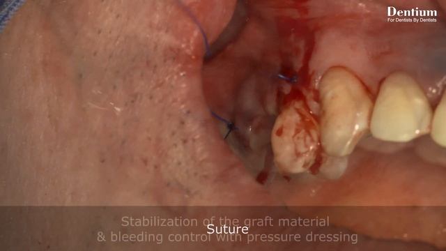 Hydraulic sinus elevation using DASK смотреть онлайн