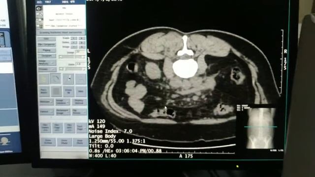 CT guided para aortic lymph node FNAC смотреть онлайн