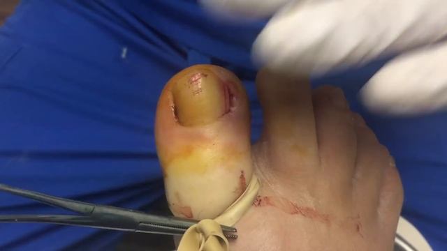 Toenail Tuesday: Bathroom Surgery Gone Wrong. Ingrown Nail Removal.