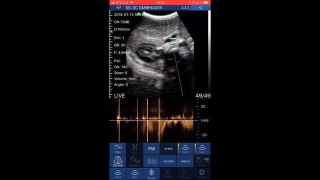 Распаковка и краткий обзор компактного ультразвукового сканера Sonostar Wireless ultrasound смотреть онлайн
