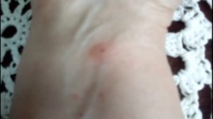 Как очень быстро убрать последствия укуса МОШКИ.