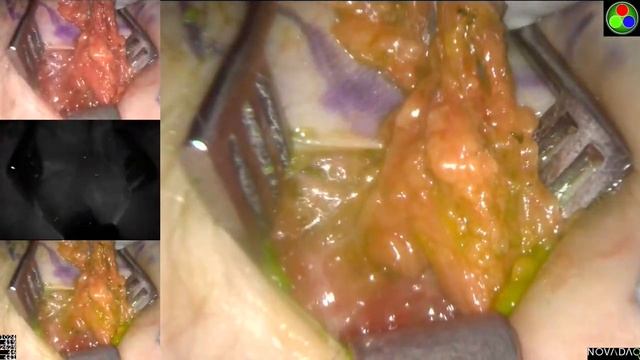 Radical Inguinal Lymphadenectomy using ICG смотреть онлайн