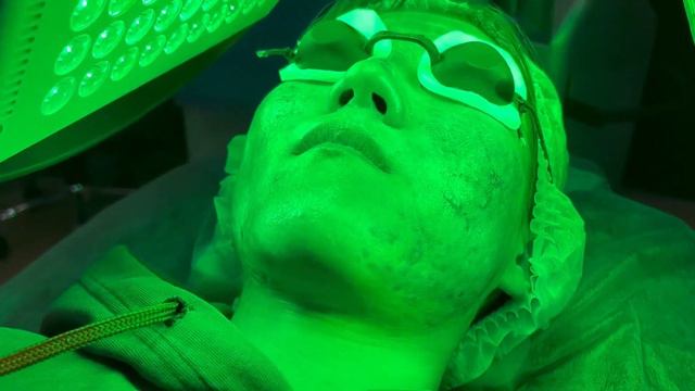 Микронидлинг с Ферменкол на рубцы постакне