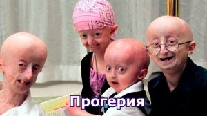 10 Самых Страшных Генетических Заболеваний Человека