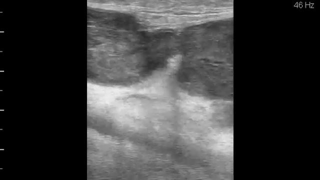 Разрыв кисты Беккера с образованием гематомы (проба с компрессией)