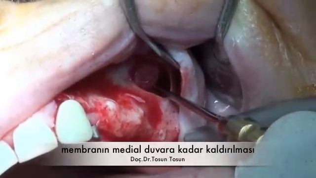 Sinus Lifting by piezoelectric ultrasonic surgery смотреть онлайн