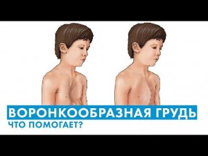 Деформация грудной клетки: нужна ли операция? какие упражнения помогают?