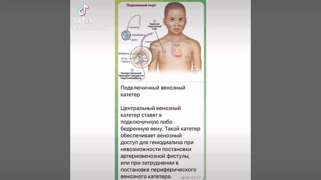 Медицина : Подключичный венозный катетер/07.09.21 смотреть онлайн