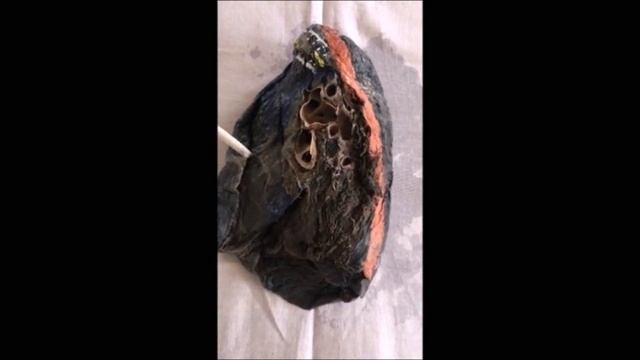 LUNGS Anatomy Part 2 смотреть онлайн
