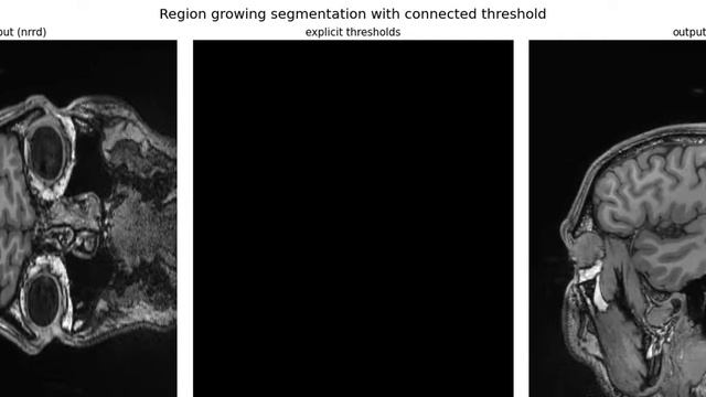 Medical Image Processing | Image Segmentation | Registration | Morphological operations | python смотреть онлайн