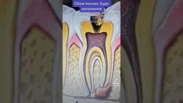 Трещина в зубе ведет к воспалению смотреть онлайн