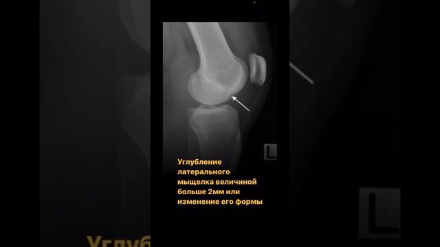 Признаки повреждения ПКС на рентгенограмме коленного сустава смотреть онлайн